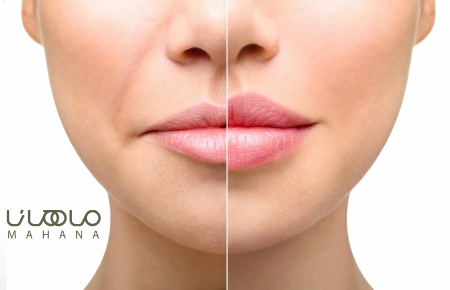 لیفت لب با نخ ماهانا