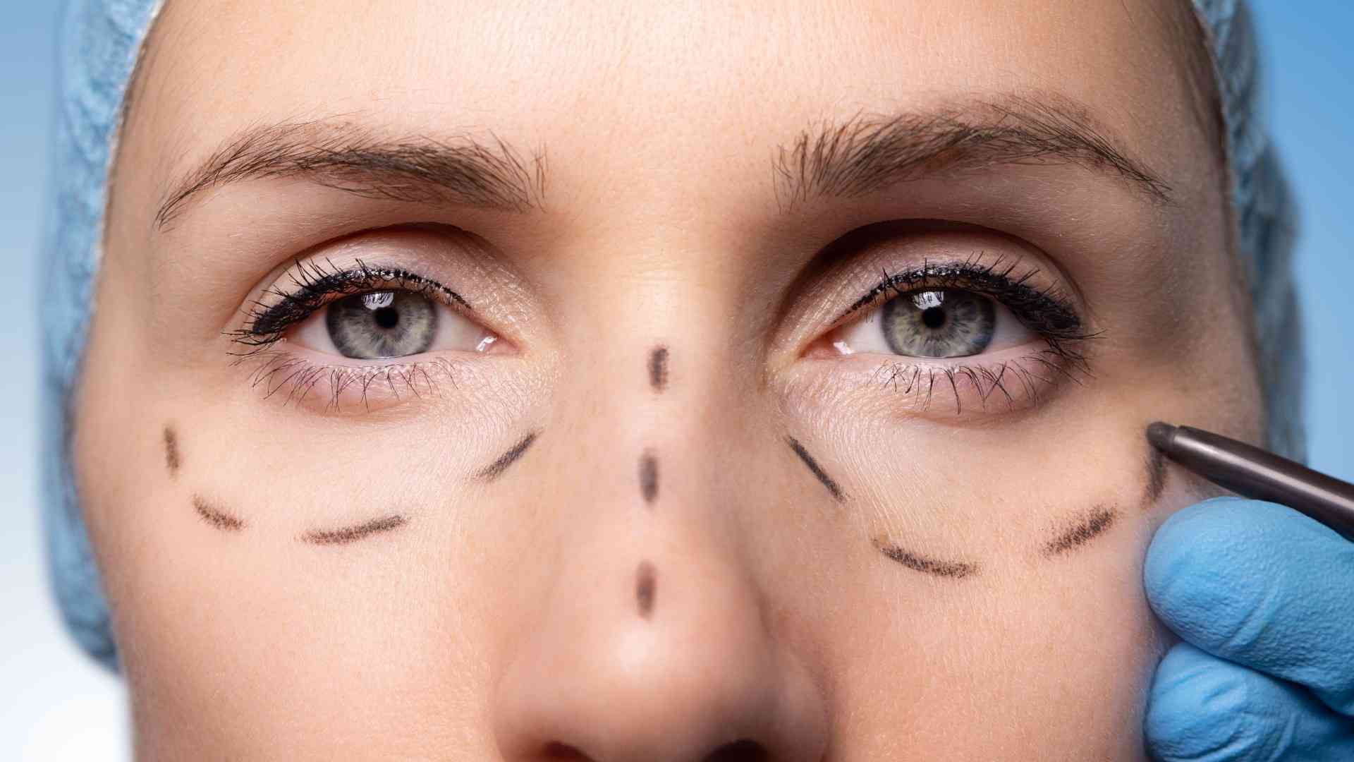 بهترین کاندیدای جراحی بلفاروپلاستی