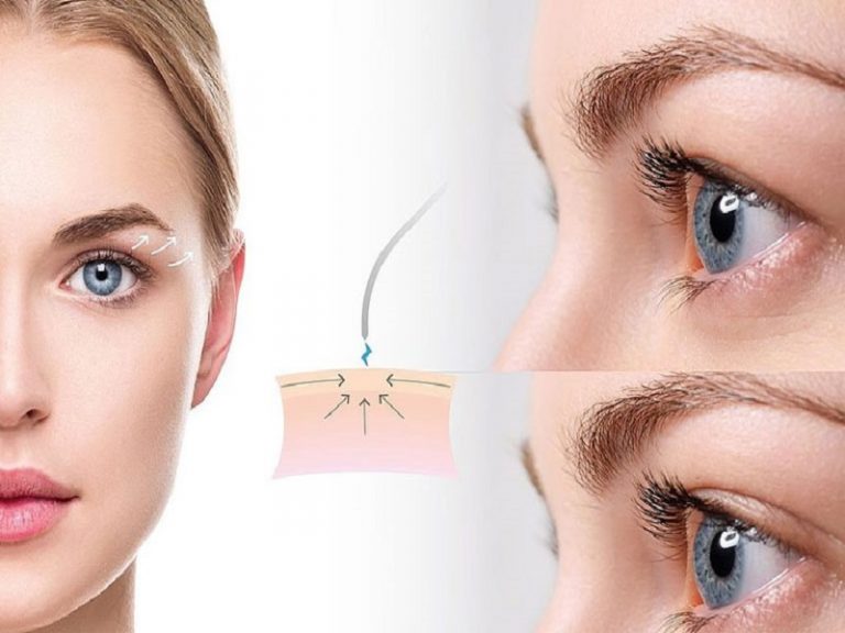 جراحی پلک با لیزر