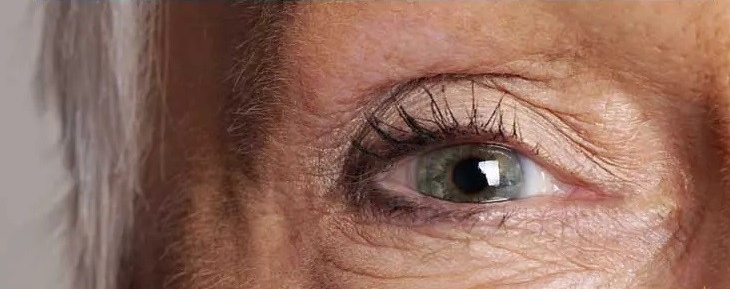 زمان مناسب برای جراحی پلک چه موقع است؟