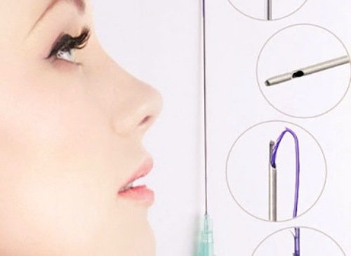 لیفت غبغب با متد نخ