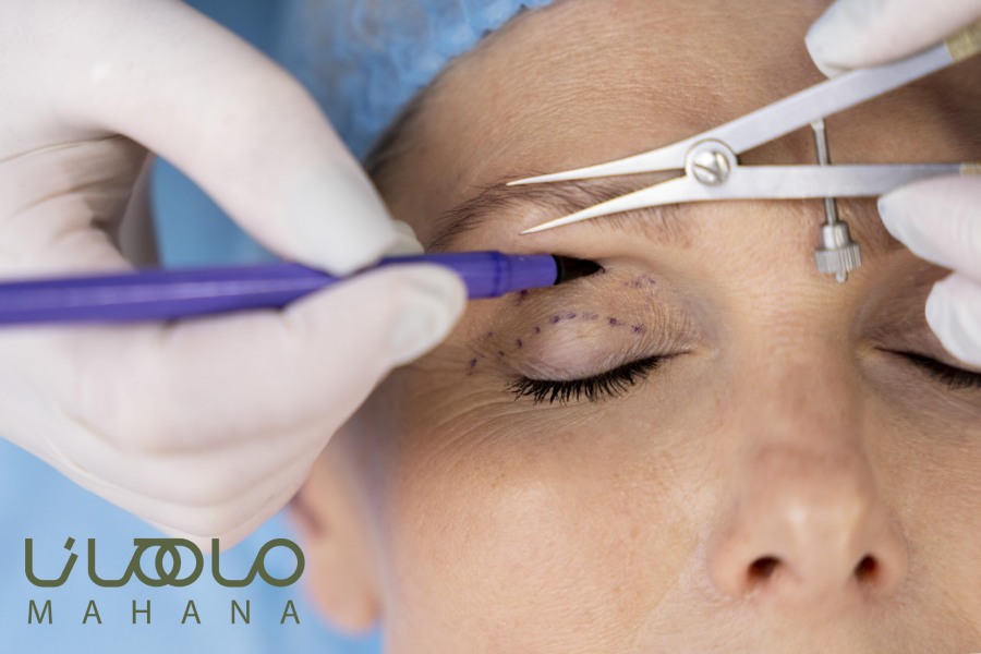 هزینه جراحی زیبایی پلک چقدر است؟ (1)