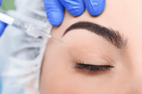 لیفت ابرو به روش اولتراپی